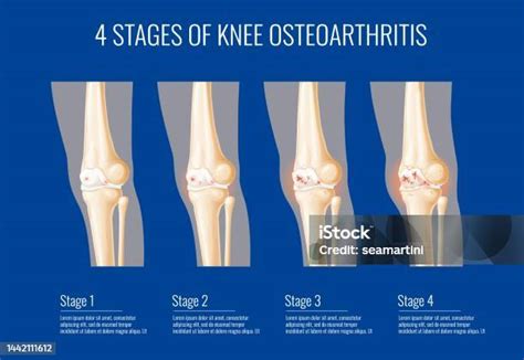 Knee Joint Osteoarthritis Stages Infographics Stock Illustration
