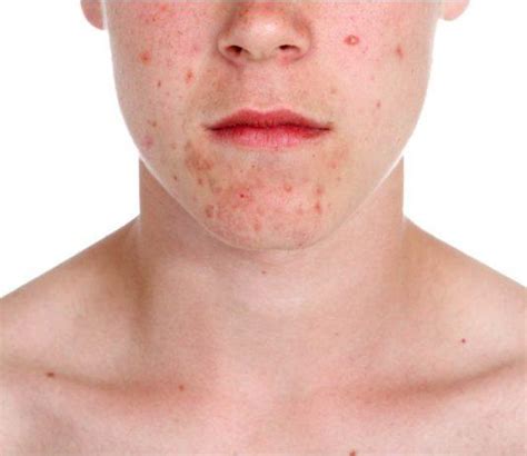 Acne Erythromycin Facial Naked Photo