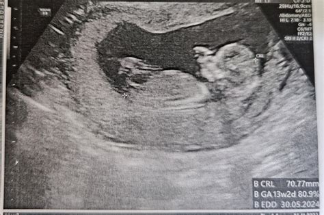 Twins Ultrasound At 12 Weeks 5 Days Any Guesses R Nubtheory