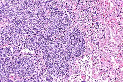 Atypical Lung Carcinoid Tumour Libre Pathology