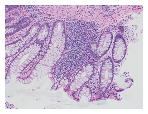 A Crypt Abscess Active Colitis In The Cecal Biopsy Specimen B