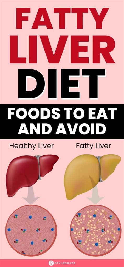 Fatty Liver Diet Plan And Foods To Eat And Avoid Artofit