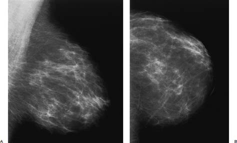 reduction mammoplasty radiology key