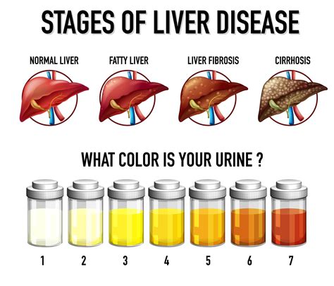 Stages Of Liver Disease 1868462 Vector Art At Vecteezy