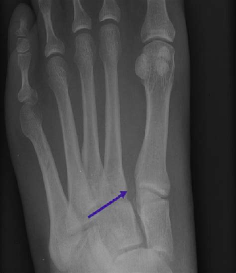 Exams today will determine how long he's out. Lisfranc Injuries - Core EM