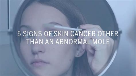5 Signs Of Skin Cancer Other Than An Abnormal Mole Health Youtube