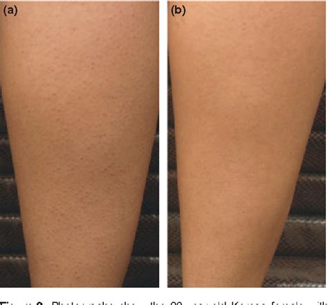 Before And After Pictures Of Keratosis Pilaris