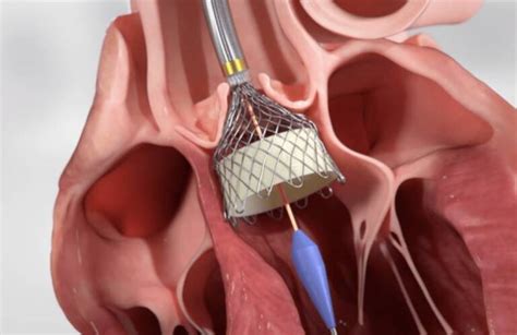 Fda Approves Two Clinical Trials For Hlts Tavr System Massdevice