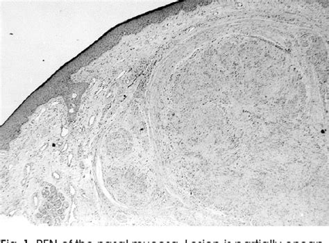 Figure 1 From Palisaded Encapsulated Neuroma Of The Nasal Fossa