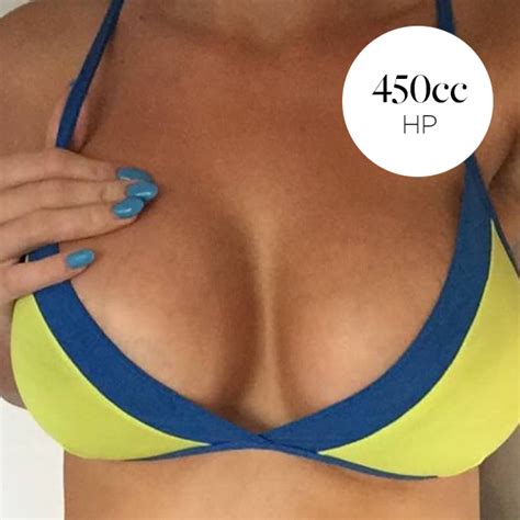 Beautiful Transformation 16 Weeks After Breast Augmentation