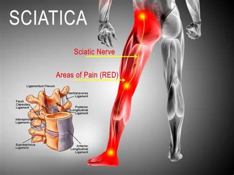 Can Sciatica Cause Knee Pain Brandon Orthopedics