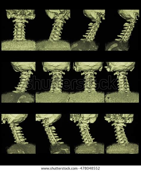 3d Ct Scan Cervical Spine Cspine Stock Photo 478048552 Shutterstock