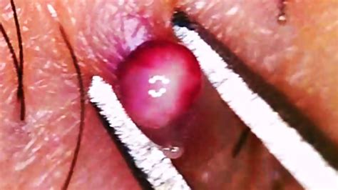 Due to the sensitive location of the bump, marisa, from milwaukee, wisconsin, wanted to get it removed. World's Best Ingrown Hair 2016 ???? - YouTube