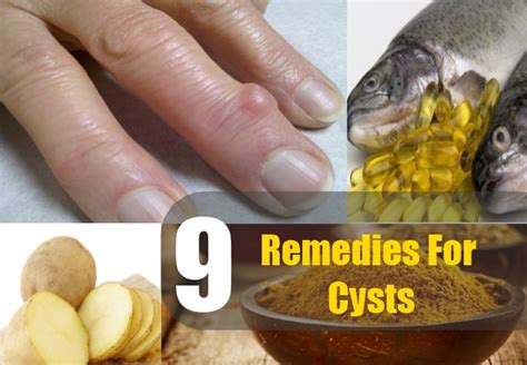 Home Remedies For Cysts Natural Treatments And Cure For Cysts Natural