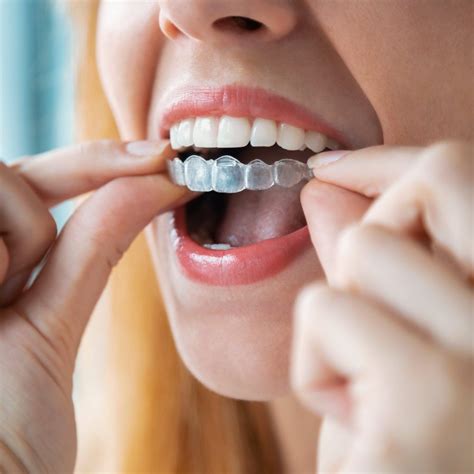 The Pros And Cons Of At Home Teeth Aligners According To A Dentist Teeth Straightening