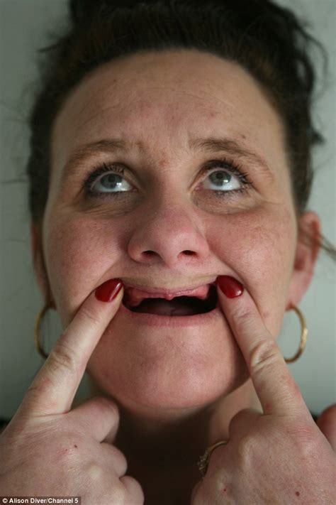 Alison Diverss German Dentist Removes All Her Teeth While She Is