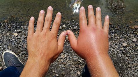 Health Conditions That Can Cause Swollen Fingers And Hands