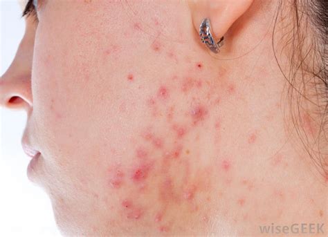 There are some conditions that look like acne, but are not actually acne. What are the Different Types of Acne Scar Removal?