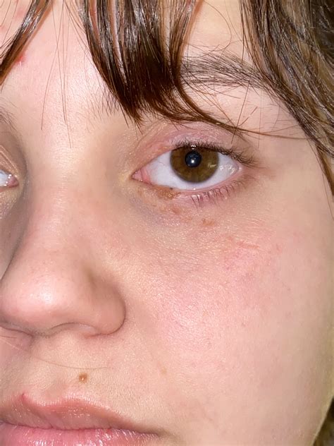 Eye Scar With Flash Eye Scar Stage Makeup Birthmark