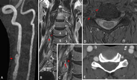 Cervical Radiculopathy Due To Extracranial Vertebral Artery Dissection My XXX Hot Girl