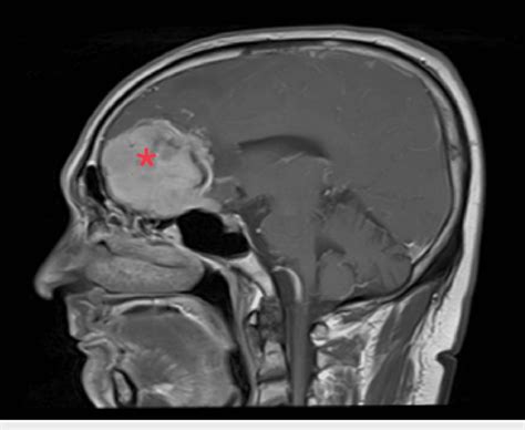 Mri Sagittal View Showing The Anterior Skull Base Meningioma Red