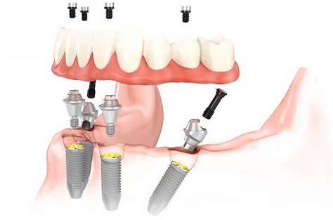 Implantes Carga Inmediata Clínica Dental Salcodent 🦷 Getafe