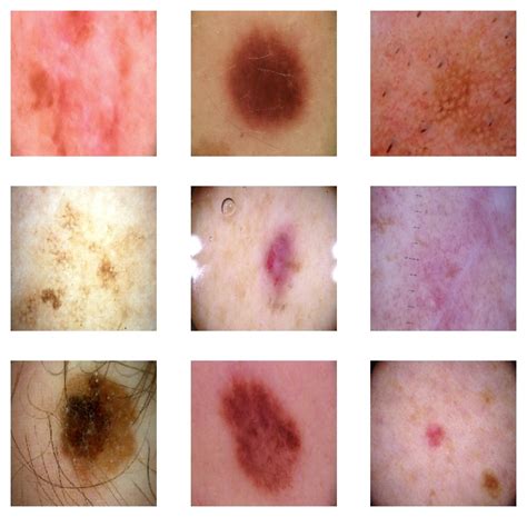 Getting Started With Kaggle Competitions Melanoma Classification