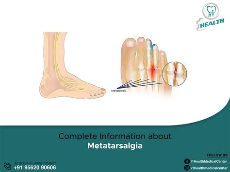 Complete Information About Metatarsalgia