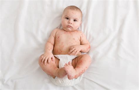 10 Penyakit Kulit Pada Bayi Dan Pengobatannya