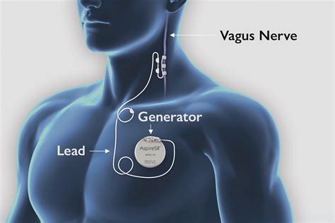 vagus nerve stimulation the epilepsy space