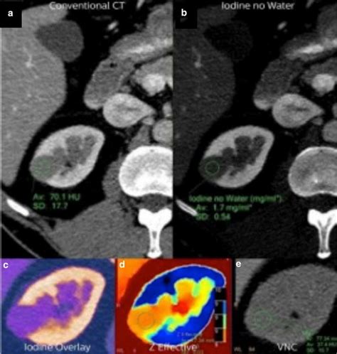 Single Source Dual Layer Dual Energy Ct In A Patient With A A