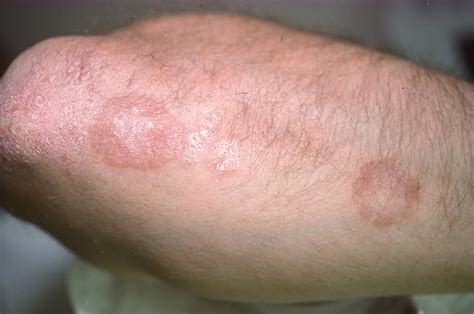 Not All Round Rashes Are Ringworm A Differential Diagnosis Of Annular