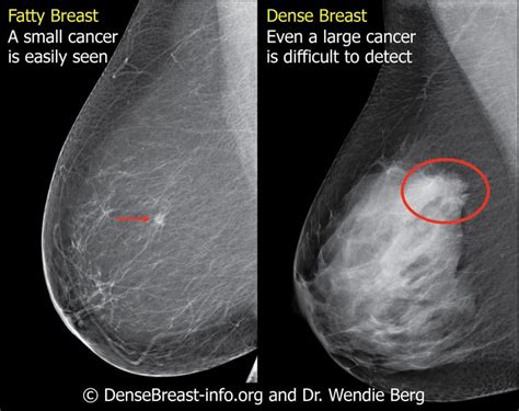 9 Best Dense Breast Info Images On Pinterest Breast Breast Cancer And Ultrasound