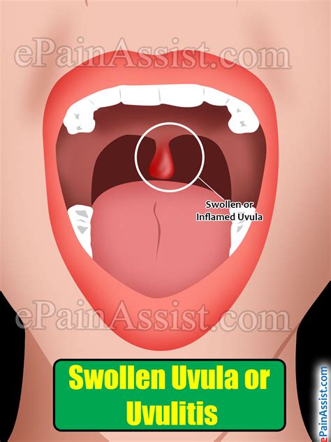 Swollen Uvula Or Uvulitiscausestreatmenthome Remediessymptoms