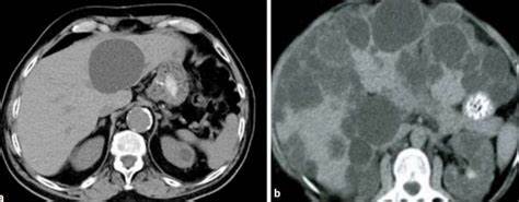 Киста в печени диета лечение Киста печени на КТ - как выглядит киста печени на томографии Киста печени на КТ - как выглядит киста печени на томографии Киста в печени диета лечение