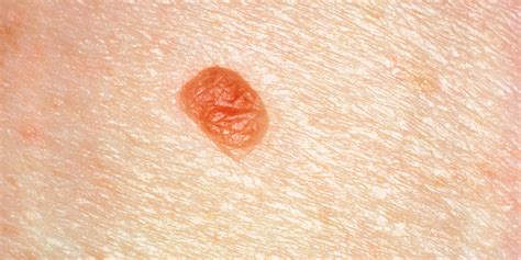 What Moles Might Have To Do With Breast Cancer Risk Huffpost