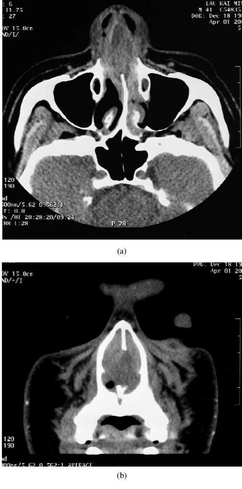 Figure From Spontaneous Nasal Septal Abscess Presenting As Complete