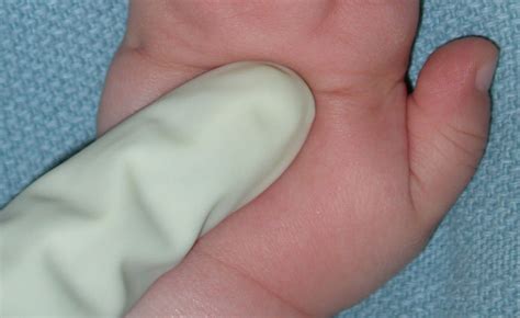 Photo Of Syndactyly Involving Four Fingers Congenital Hand And Arm