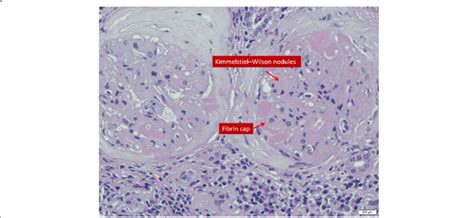Colpisce i piccoli vasi del glomerulo e' caratterizzata da una sindrome. Kimmelstiel-Wilson nodules | Download Scientific Diagram