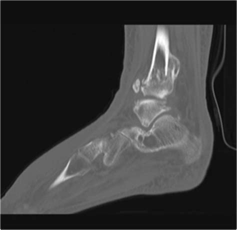 Delayed Reconstruction Of Post Traumatic Ankle Malunion A Case Report