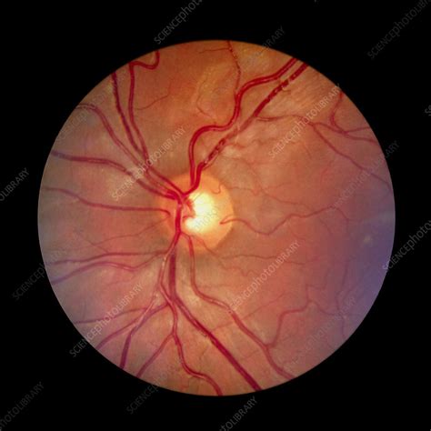 Fundus Camera Image Of A Normal Retina Caucasian Stock Image P424