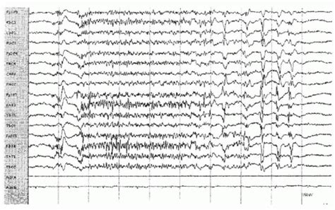 Atypical Absence Myoclonic Tonic And Atonic Seizures Neupsy Key