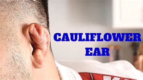 Cauliflower Ear 101 Youtube