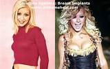 Celebrity Breast Augmentation Doctors Photos