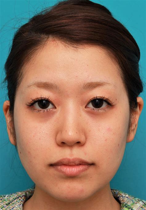メソシェイプフェイス（顔専用の脂肪溶解注射）で小顔になった20代女性の症例写真：美容外科 高須クリニック