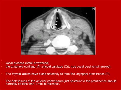 Larynx Imaging 1st Part Laryngeal Anatomy Ct Mri Dr Ahmed Esawy