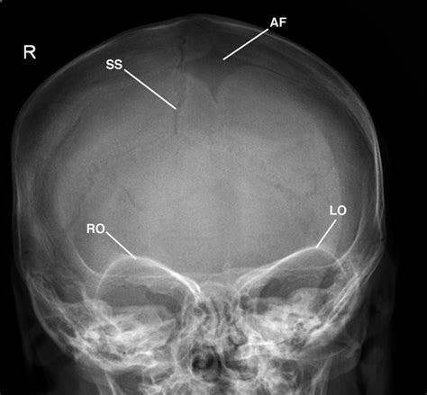 Skull Radiographs Anatomy Pediagenosis Porn Sex Picture