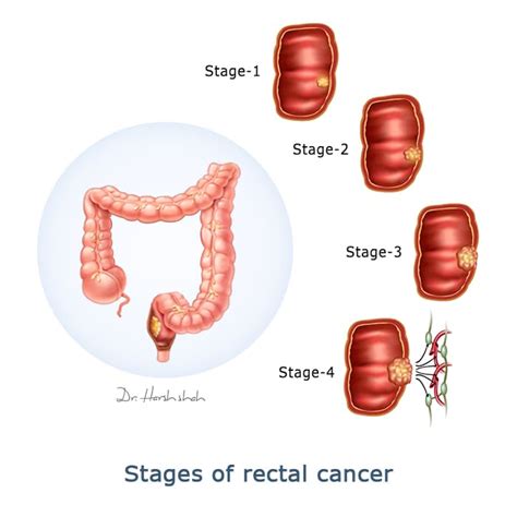 Rectal Cancer Dr Harsh J Shah