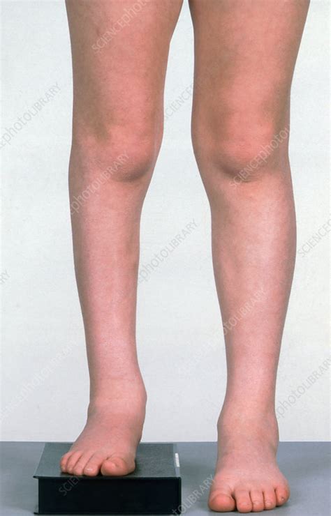 Paralysis Short Leg Stock Image C0366339 Science Photo Library