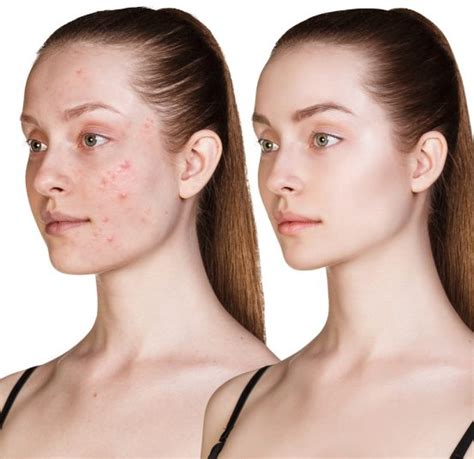 Woman With Acne Before And After Treatment Over White Background All